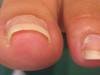 巻き爪はポピュラーな病気。正しい爪の切り方を知り、正しい靴選びをする事で予防可能です。